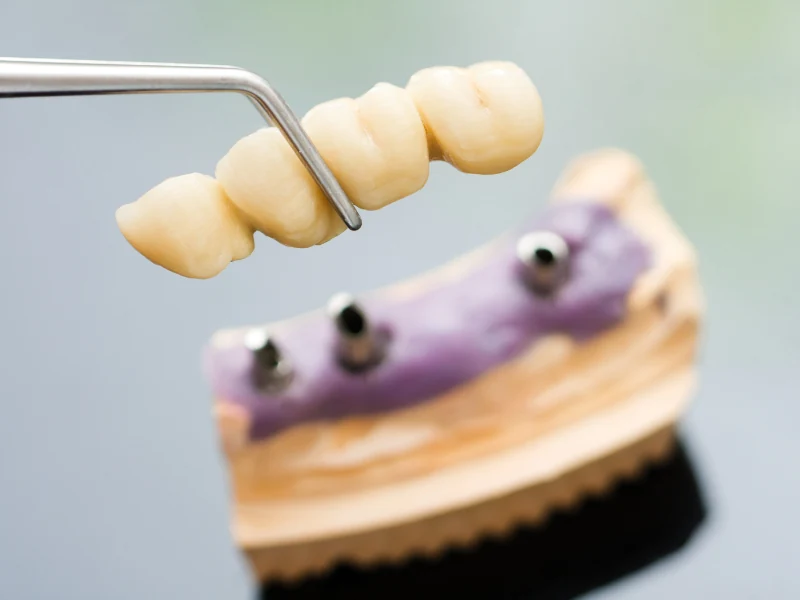 کاشت دندان مصنوعی ثابت بدون ایمپلنت - بریج