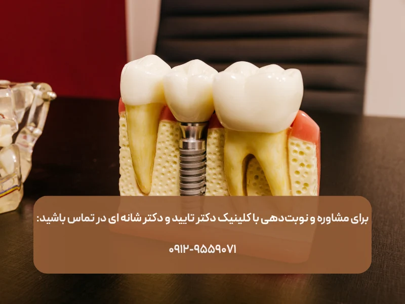 ایمپلنت دندان بهتر است یا پروتز دندان