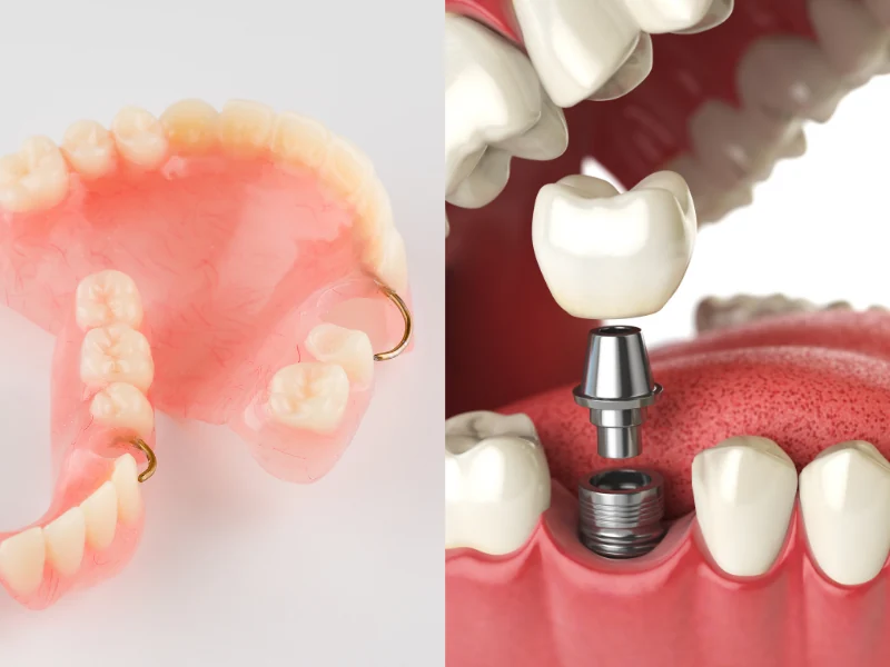 تفاوت پروتز ثابت و ایمپلنت | کدام روش بهتر است؟