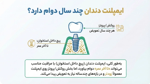 ایمپلنت چند سال دوام دارد؟ راز ماندگاری ایمپلنت