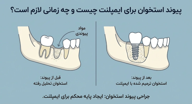 جراحی پیوند استخوان برای ایمپلنت چه زمانی لازم است؟
